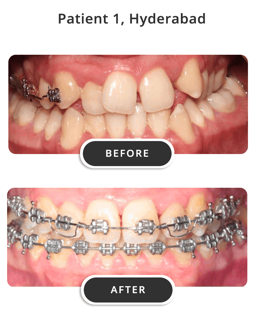 Braces 1