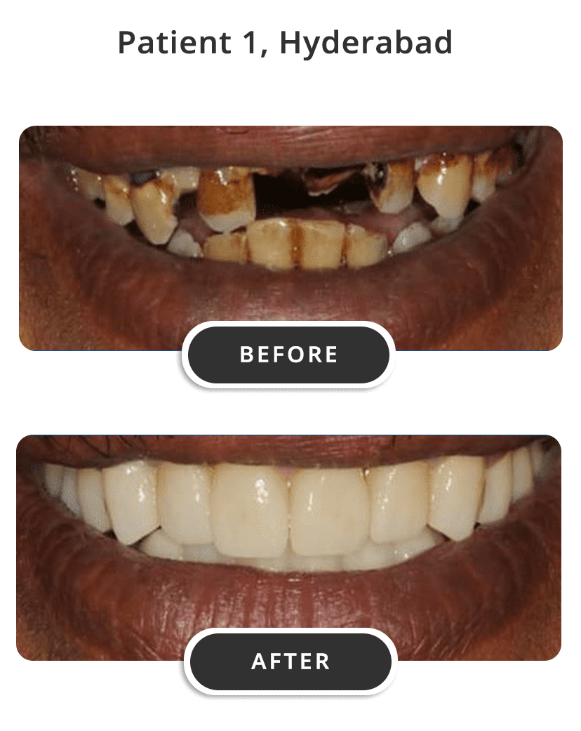 Dental Implants M1