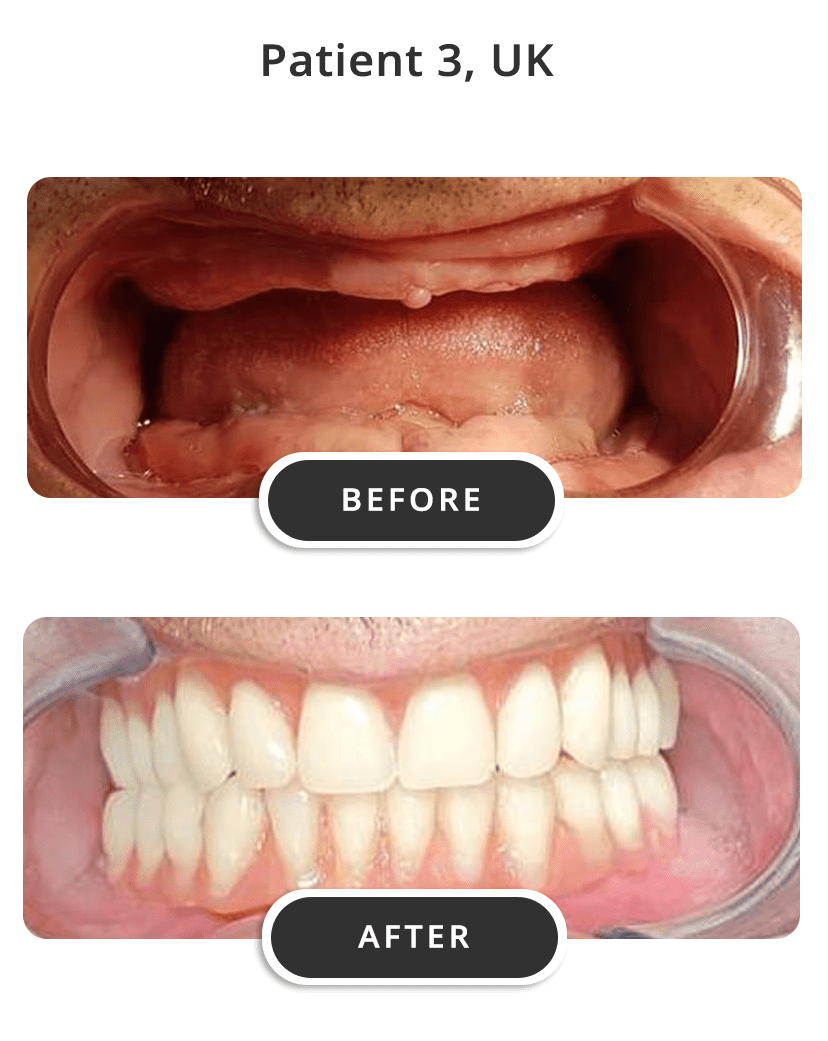 Dental Implants M3