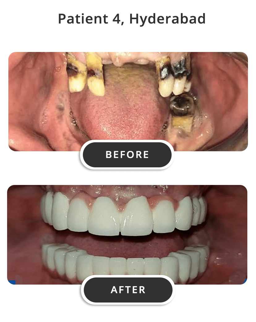 Dental Implants M4