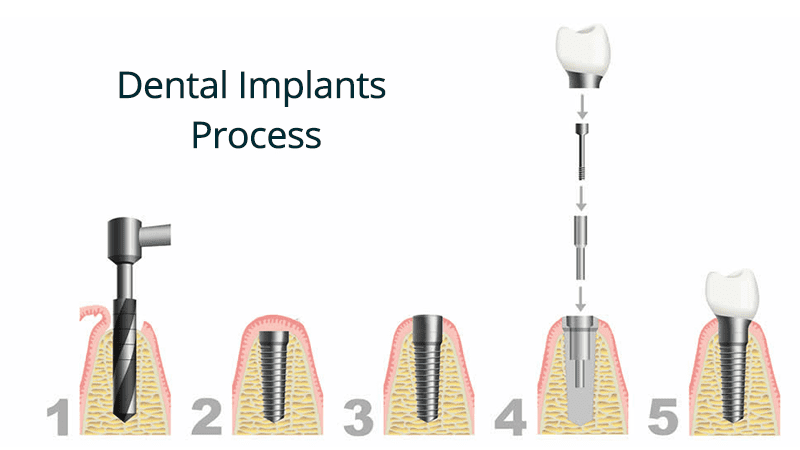 Implants 11