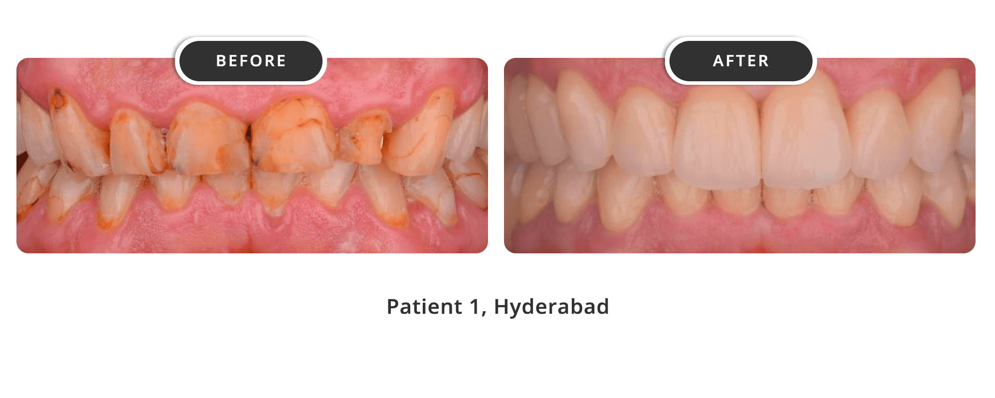 Root Canal 1