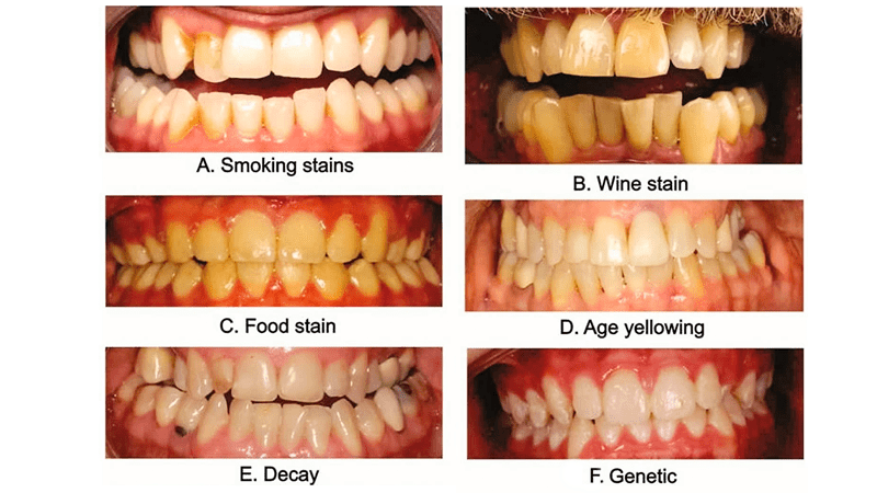 whitening 11